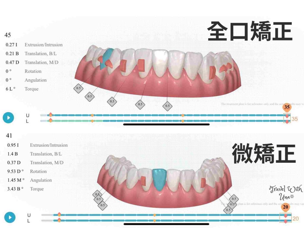 3D模擬治療計畫 Zenyum全口矯正&微矯正