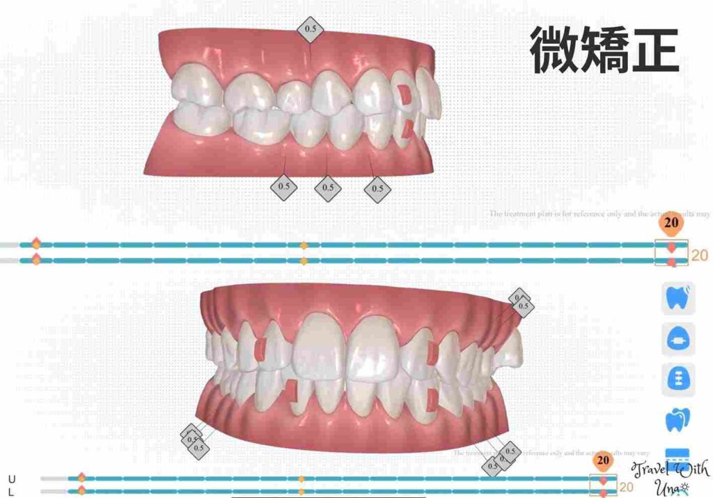 3D模擬治療計畫 Zenyum微矯正