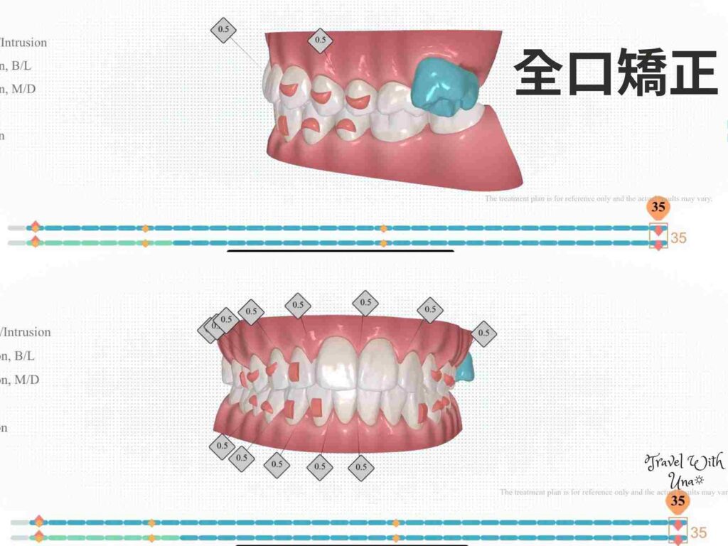 3D模擬治療計畫 Zenyum全口矯正